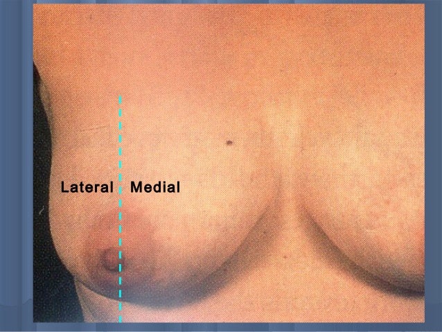 bb lump on breast Bb lump on breast